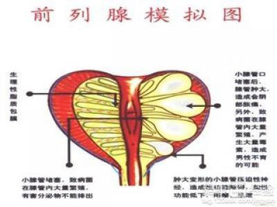 前列腺炎最新療法的研究、應(yīng)用與實踐探索