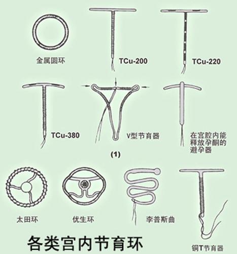 最新節(jié)育環(huán)研究進(jìn)展與應(yīng)用概述